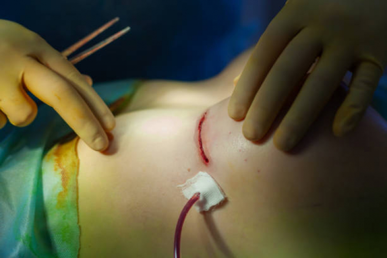 Cirurgia de Colocar Silicone Moinho - Cirurgia para Redução de Mamilos