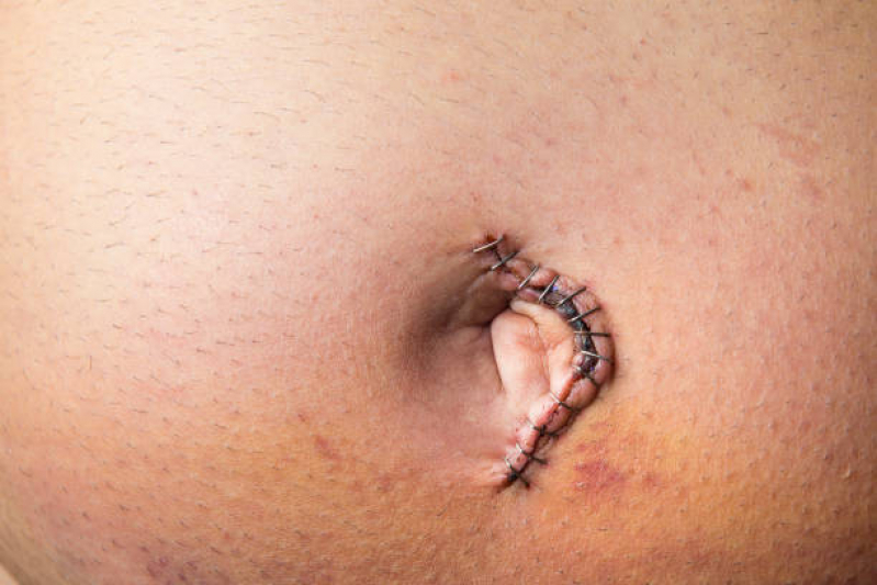 Cirurgia de Hérnia Abdominal Perdizes - Hérnia Umbilical Cirurgia por Videolaparoscopia