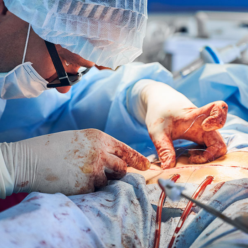 Cirurgia de Implante de Cateter Marcar Vila Romana - Cirurgia de Escleroterapia