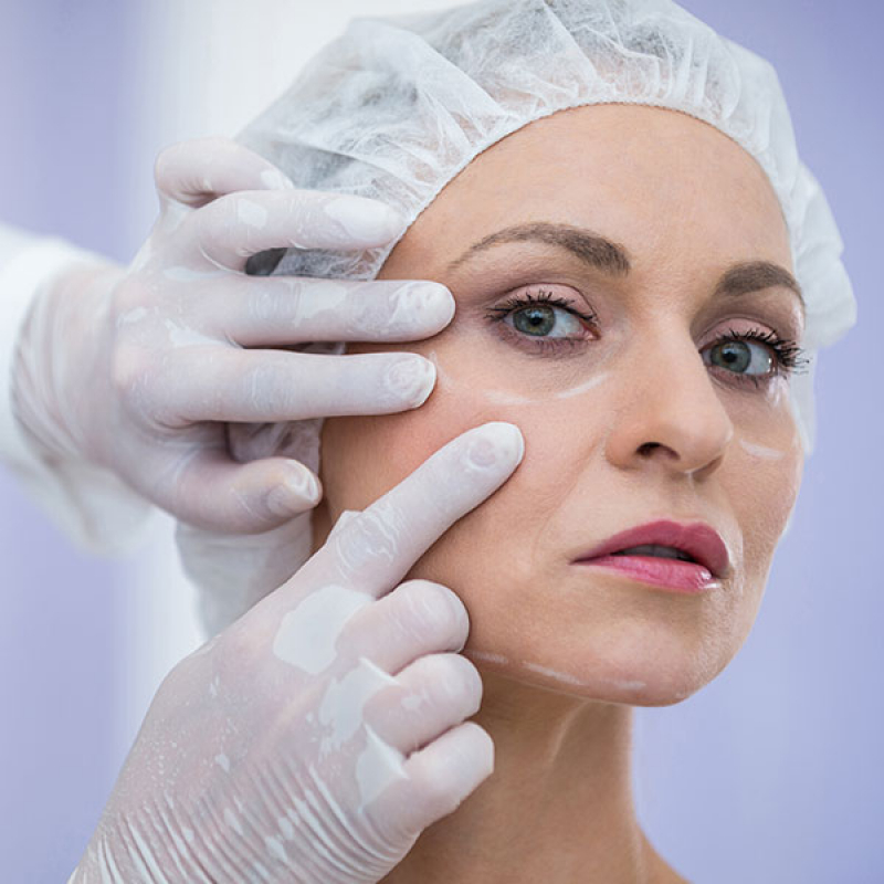 Cirurgia de Lifting Facial Agendar ABCDM - Cirurgia Plástica Reparadora