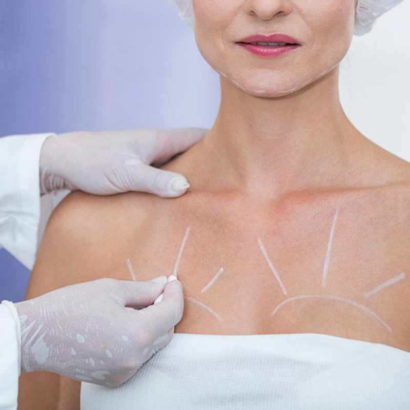 Cirurgia de Mamoplastia Moinho - Cirurgia de Lifting Facial