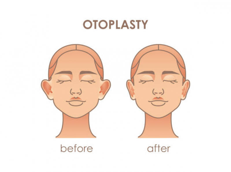 Cirurgia de Redução de Orelha Panamby - Cirurgia Otoplastia