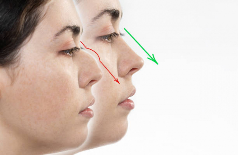Cirurgia Plástica no Nariz Marcar Chácara Inglesa - Cirurgia Plástica Facial