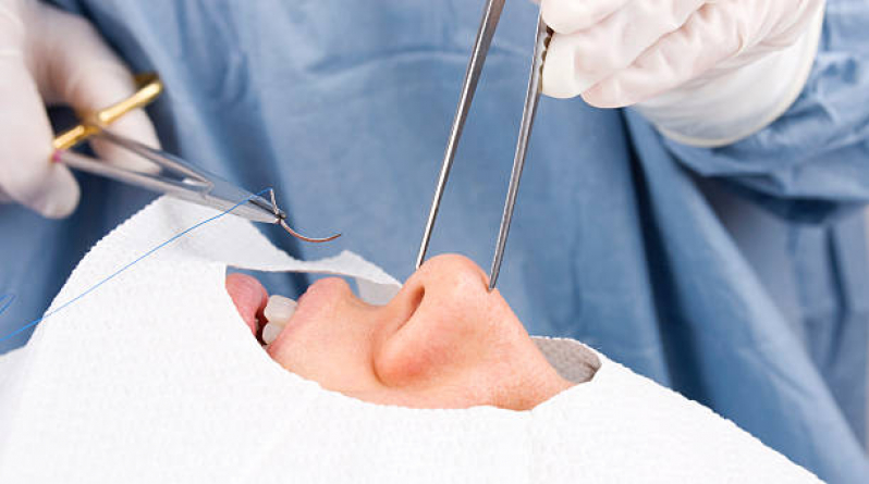 Cirurgia Rinoplastia Cirurgia Itaquaquecetuba - Cirurgia Rinoplastia Estética