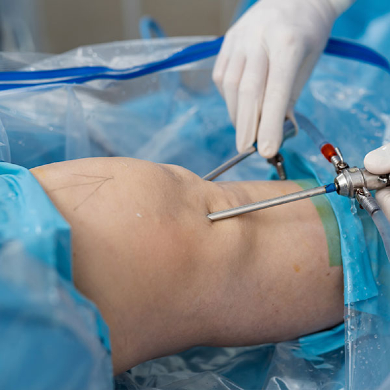 Cirurgia Vascular Santa Cecilia - Cirurgia de Implante de Cateter