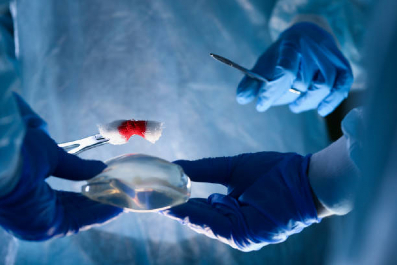 Clínica Que Realiza Cirurgia Plástica Prótese de Mama Cambuci - Cirurgia de Prótese de Silicone Submuscular
