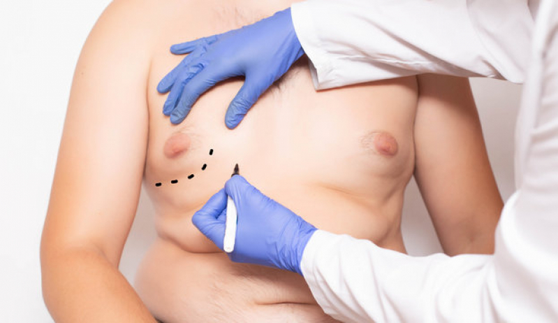 Ginecomastia Cirurgia Carapicuíba - Ginecomastia em Homem
