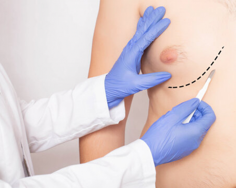 Ginecomastia em Mulheres Cotar Faria Lima - Ginecomastia Cirurgia