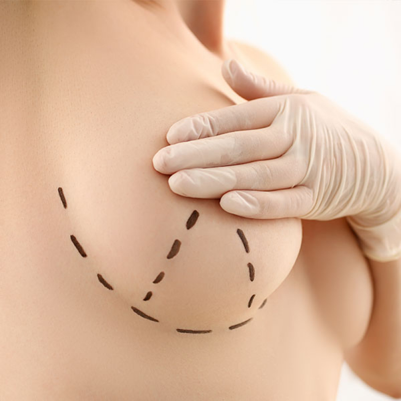 Onde Agendar Cirurgia de Mamoplastia Carapicuíba - Cirurgia de Rinoplastia