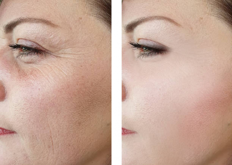 Blefaroplastia