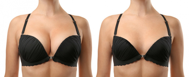 Mamoplastia para Redução