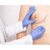 agendar cirurgia de ginecomastia feminina Vila Pompeia