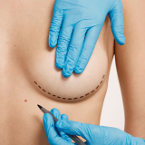 cirurgia de implante mamário agendar ABCD