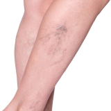 cirurgia de vasos nas pernas Embu-Guaçu