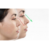 cirurgia plástica no nariz marcar Campos Elíseos