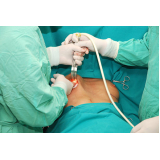 Ginecomastia Feminina Cirurgia