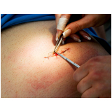 hérnia umbilical cirurgia a laser contato Vargem Grande Paulista