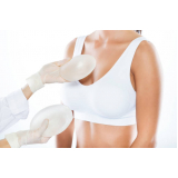implante de prótese mamária Parque Maria Domitila