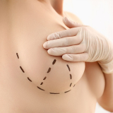 onde agendar cirurgia de mamoplastia Suzano